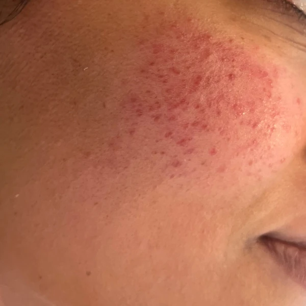 Rosacea: Ook een Zorg voor de Donkere Huid